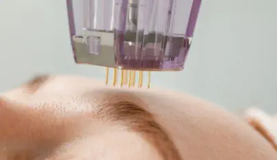 Close-up of advanced SkinPen microneedling treatment being performed at Kansas City's premier Aesthetics For Women clinic. Precision therapy stimulating collagen production and skin rejuvenation using FDA-approved technology, available exclusively in the 