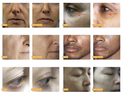 Advanced Tixel 2 skin resurfacing treatment available exclusively at Kansas City's Aesthetics For Women clinic. Experience Missouri's most innovative thermal collagen stimulation therapy for rejuvenated, smoother skin. Trust KC's premier med spa for this 