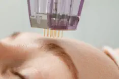 Close-up of advanced SkinPen microneedling treatment being performed at Kansas City's premier Aesthetics For Women clinic. Precision therapy stimulating collagen production and skin rejuvenation using FDA-approved technology, available exclusively in the 
